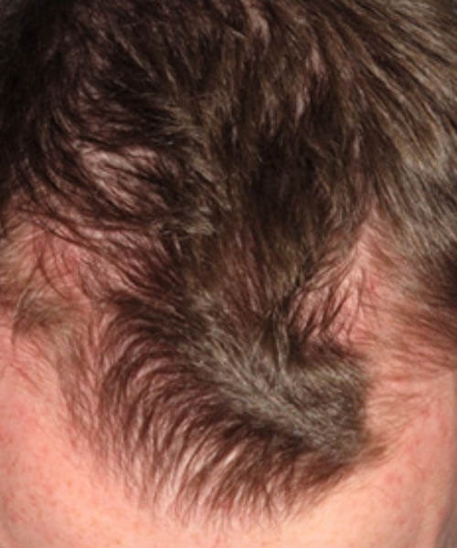 A man showing his less hair before lasercap treatment