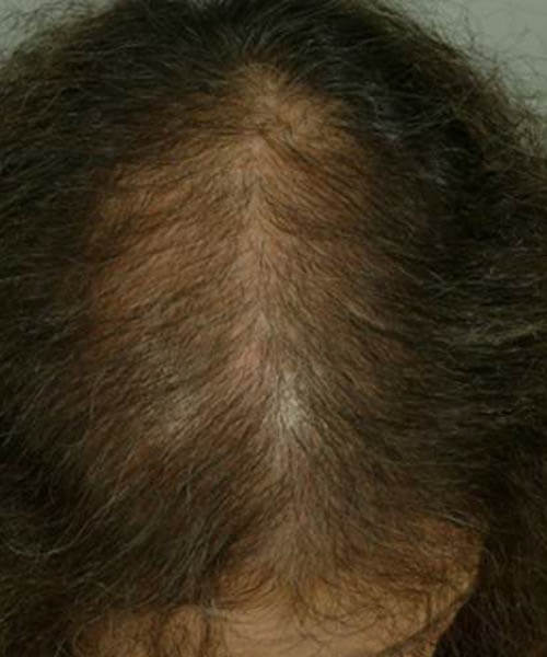 A woman showing her scalp and less hair before lasercap treatment