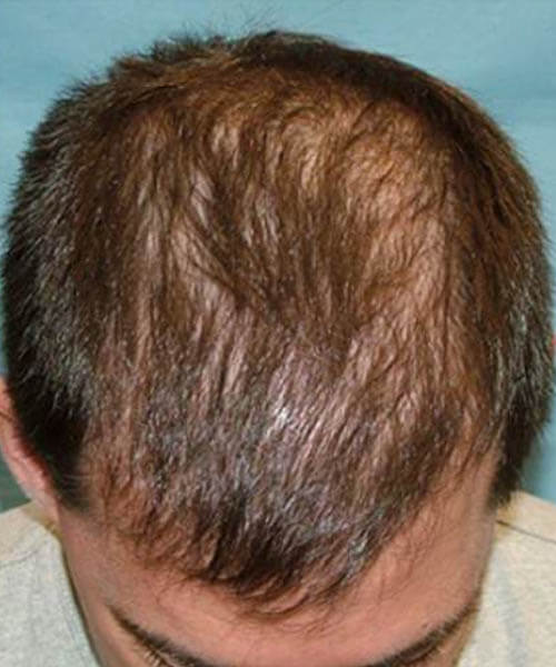 A man showing his scalp before lasercap treatment