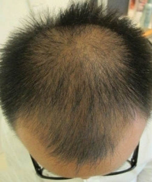A man with less hair showing his scalp before using lasercap