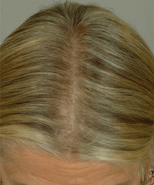Women with light golden hair after lasercap treatment