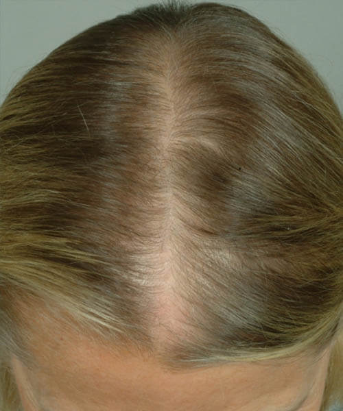A woman showing her light golden hair before lasercap treatment