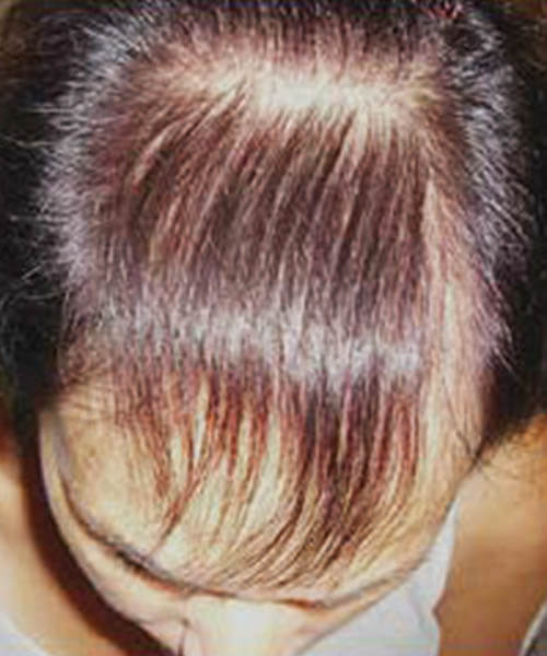 A woman showing her less hair before lasercap treatment