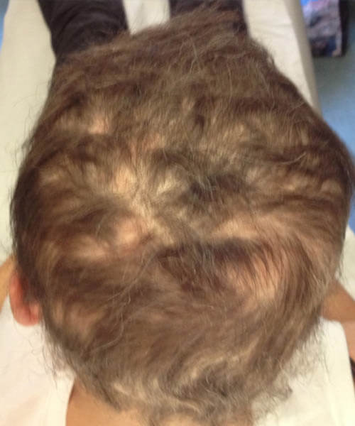 A kid showing his scalp and less hair before using lasercap