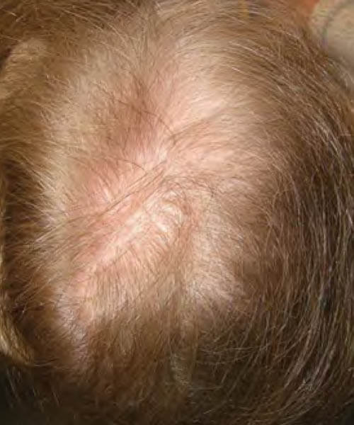 A woman with golden brown hair before treatment