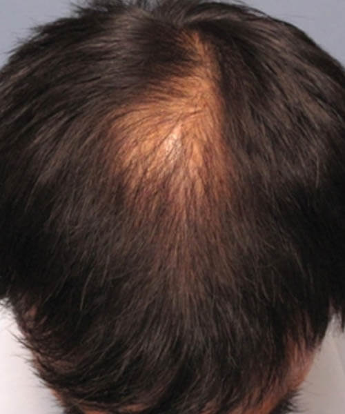 man hair after using lasercap