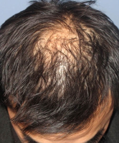 Men showing his scalp and hair before lasercap treatment