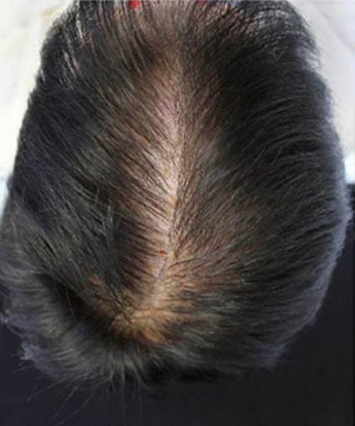 A man showing his black hair after lasercap treatment