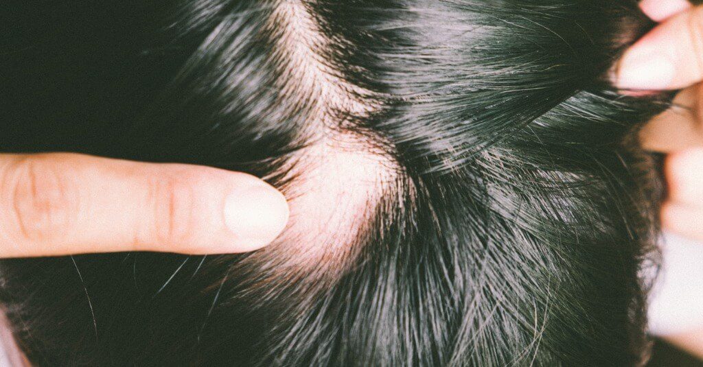 What Is Alopecia?