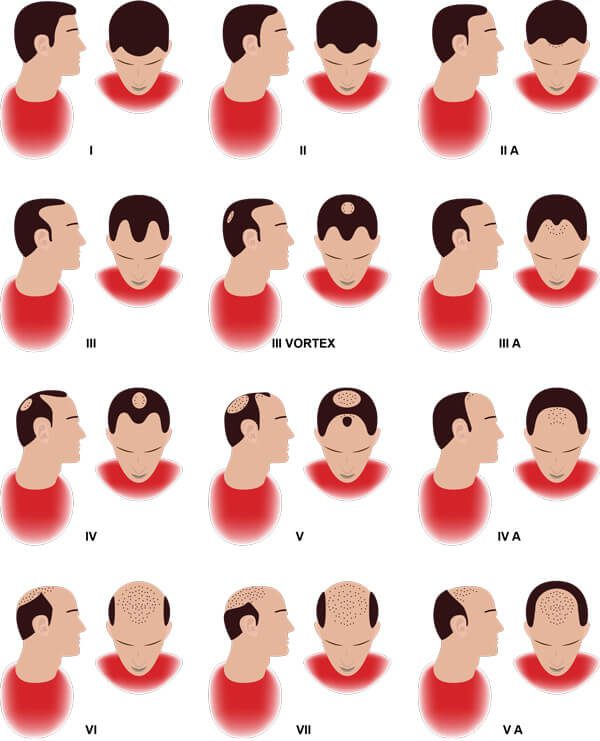 The Hamilton-Norwood Scale, Showing Common Patterns And Progression Of Androgenic Alopecia In Men.