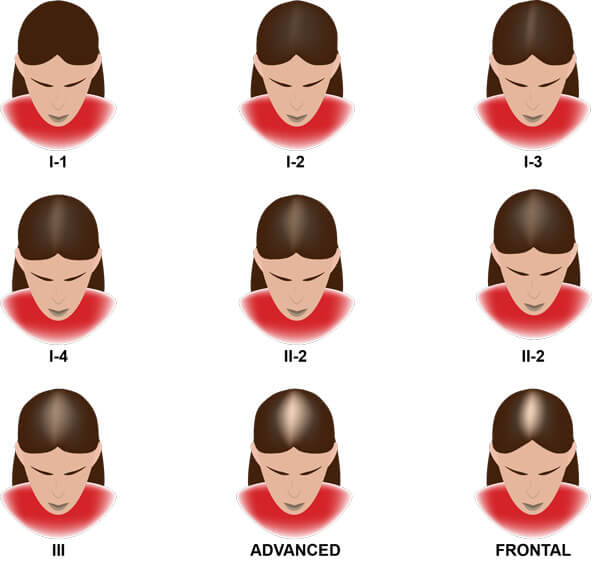The Ludwig-Savin Scale, Showing Common Patterns And Progression Of Androgenic Alopecia In Women.