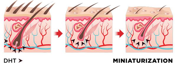 Excessive Miniaturization Of Hair Follicles Results In Areas Of Thinning And Baldness