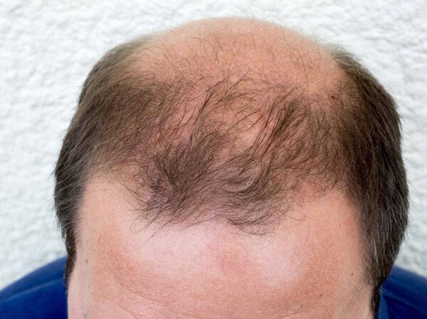 Excessive Miniaturization Of Hair Follicles Results In Areas Of Thinning And Baldness