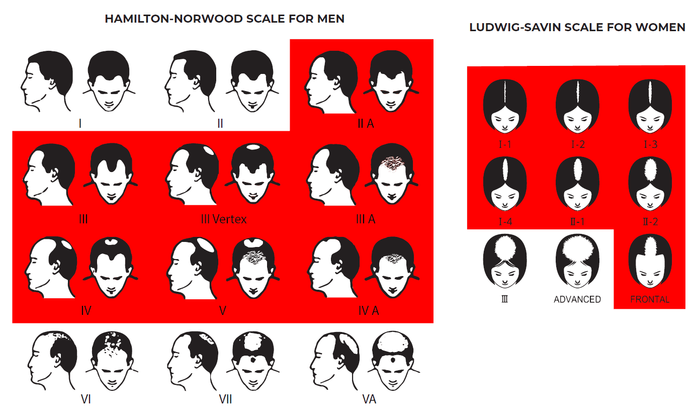 Illustration of hamilton nordwood scale for men and ludwig savin scale for women