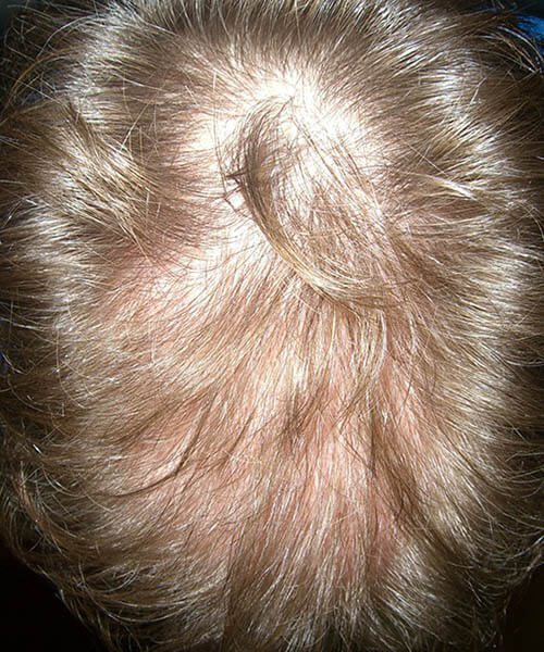 A man showing his scalp and less hair