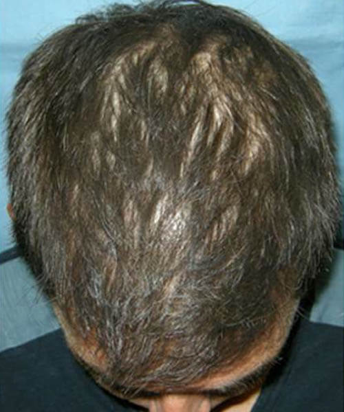 A man showing his scalp and hair after using lasercap