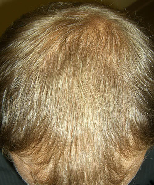 A man showing his scalp and brown hair after using lasercap