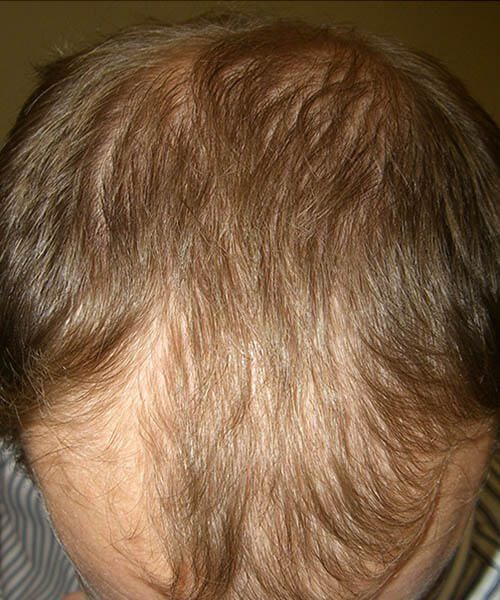 Man showing his scalp and hair