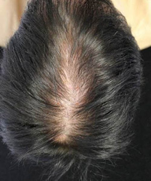 A man with black hair before lasercap treatment