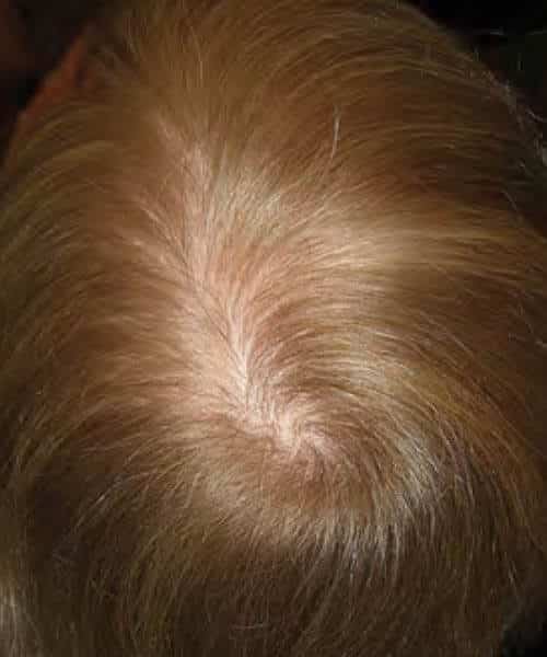 A man with silky golden hair after lasercap treatment