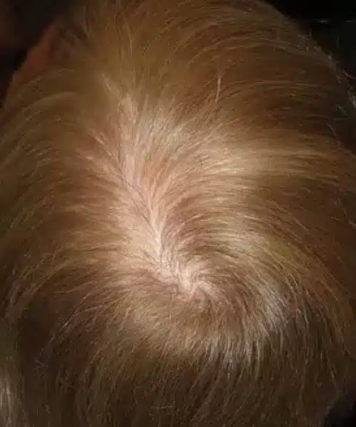 A woman with Golden hair after lasercap treatment