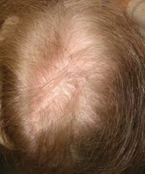 A woman with Golden hair before lasercap treatment